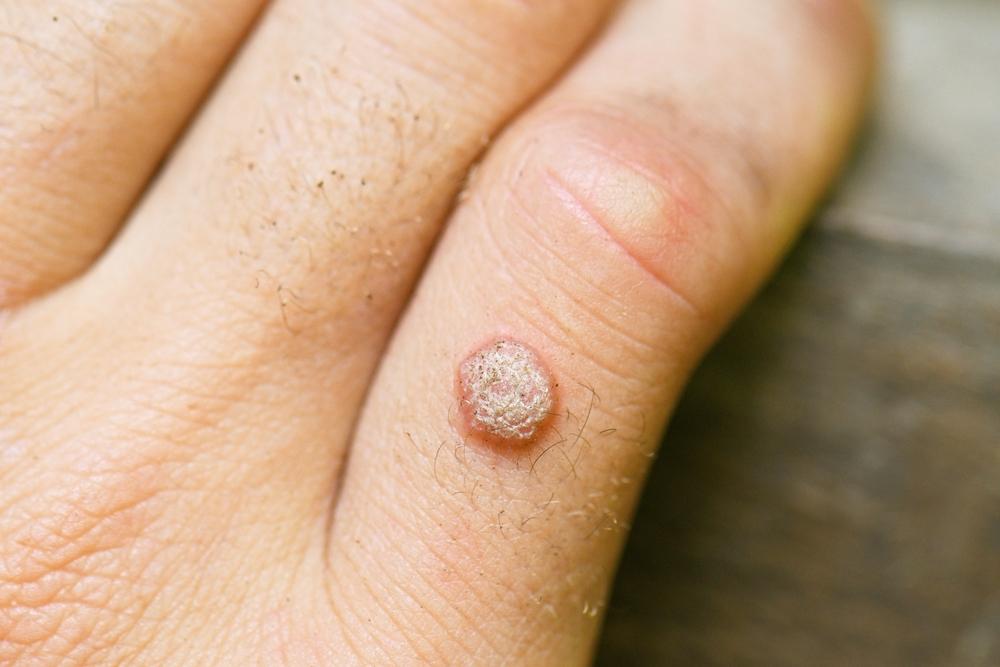 Painlessly Banish Warts: The 1064-nm Laser Revolution!