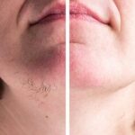Zap Unwanted Hair Away: Real At-Home IPL Results