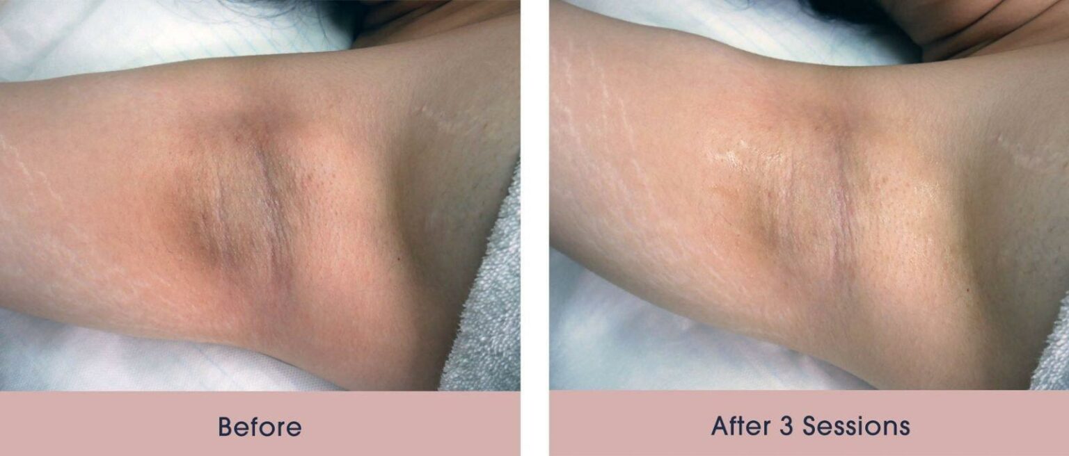 Underarm Laser Whitening: Bright Results, Dark Side Effects?