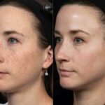 Unmasking the Future: Long-Term Effects of Facial Lasers