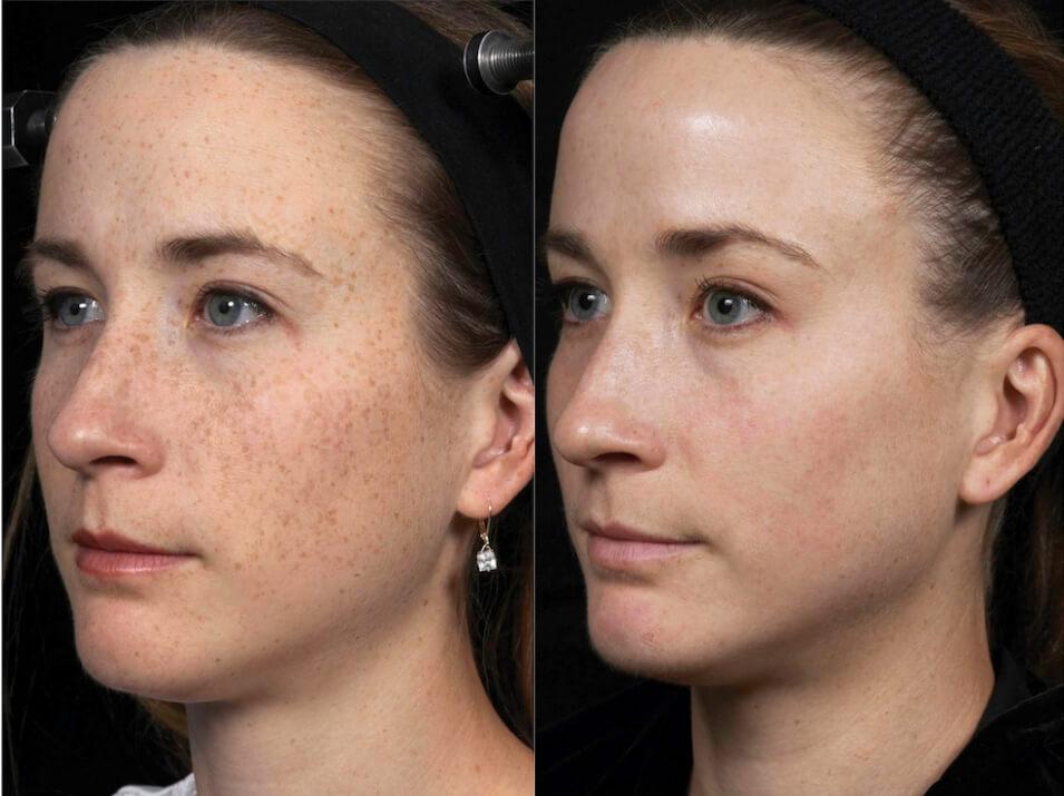 Unmasking the Future: Long-Term Effects of Facial Lasers