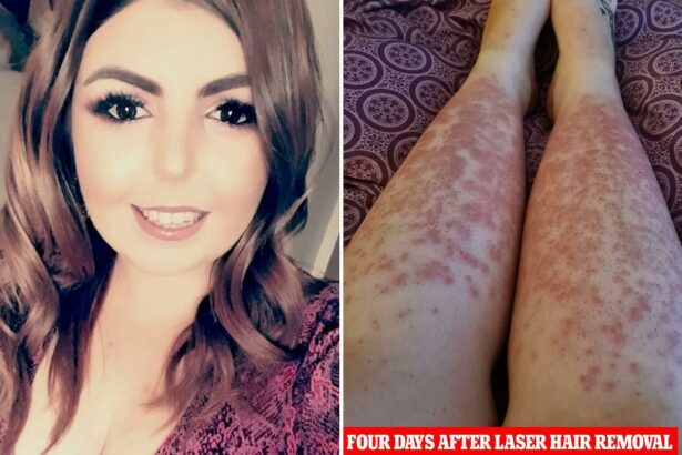 Post-Laser Hair Removal: Can You Hit the Gym?