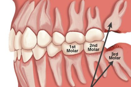 Post-Surgery Guide: Wisdom Teeth Recovery at Amarillo Oral 14 Post-Surgery Guide: Wisdom Teeth Recovery at Amarillo Oral
