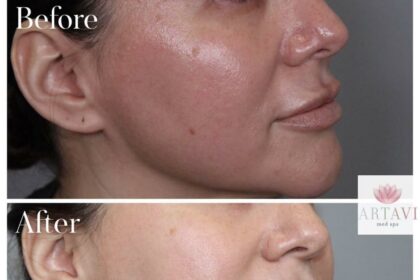 Post-Laser Glow: Essential Care for Smooth Underarms 4 Post-Laser Glow: Essential Care for Smooth Underarms