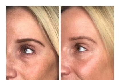 Post-Laser Glow: Essential Aftercare Tips for Smooth Skin