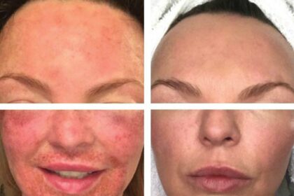 Post-Laser Grace: Essential Hair Removal Aftercare Tips