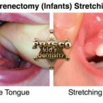 Post-Laser Frenectomy Care Tips for Chicago Residents