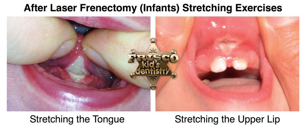 Post-Laser Frenectomy Care Tips for Chicago Residents