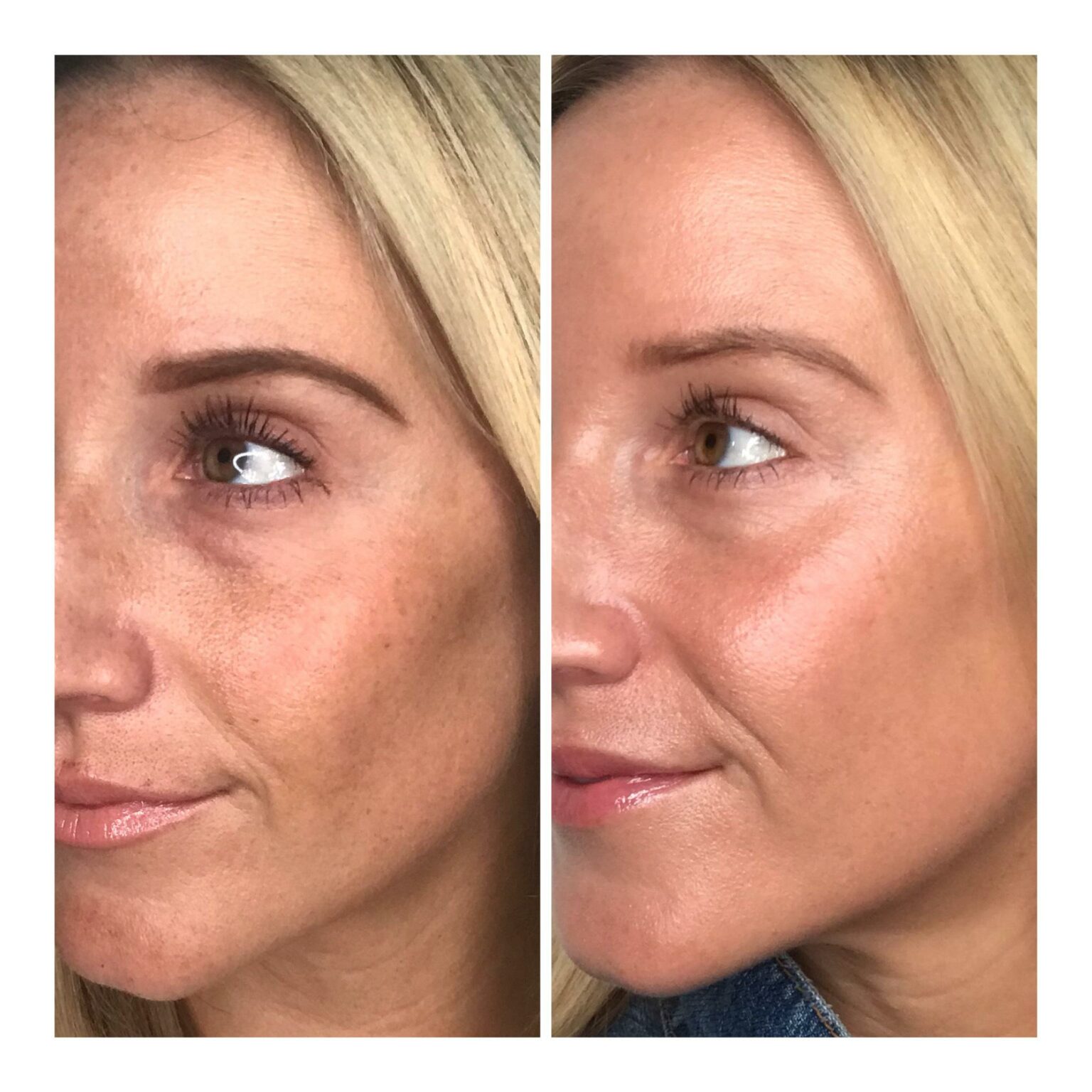 Post-Laser Glow: Essential Aftercare Tips for Radiant Skin