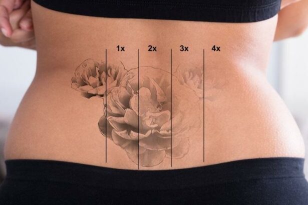 Ultimate Guide: Essential Tips for Laser Tattoo Aftercare