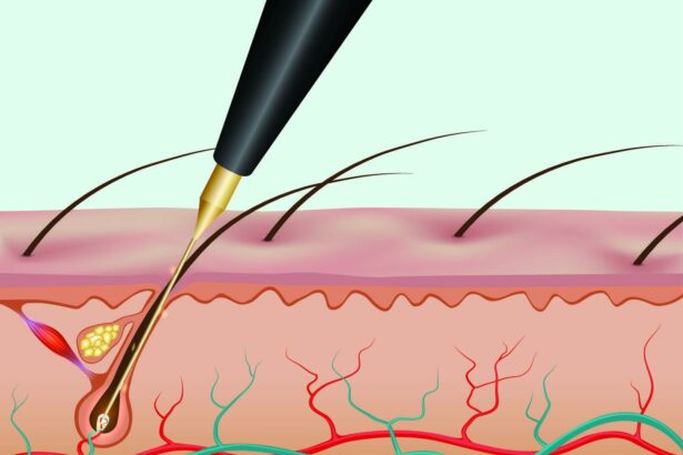 The Long-term Impact of Electrolysis: Myths vs. Reality
