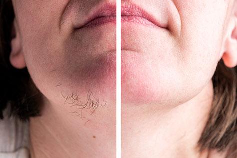 Zap Unwanted Hair: Why Home Light Devices Really Work!
