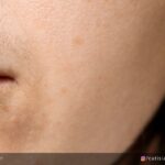Say Goodbye to Peach Fuzz: Upper Lip Laser Magic!