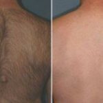 Zap Away the Hair: Back Laser Removal Costs Explained!