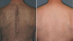 Zap Away the Hair: Back Laser Removal Costs Explained!