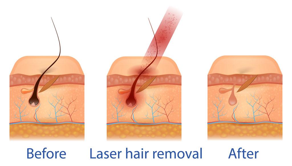 Laser Pubic Hair Removal: Real Before & After Revealed!