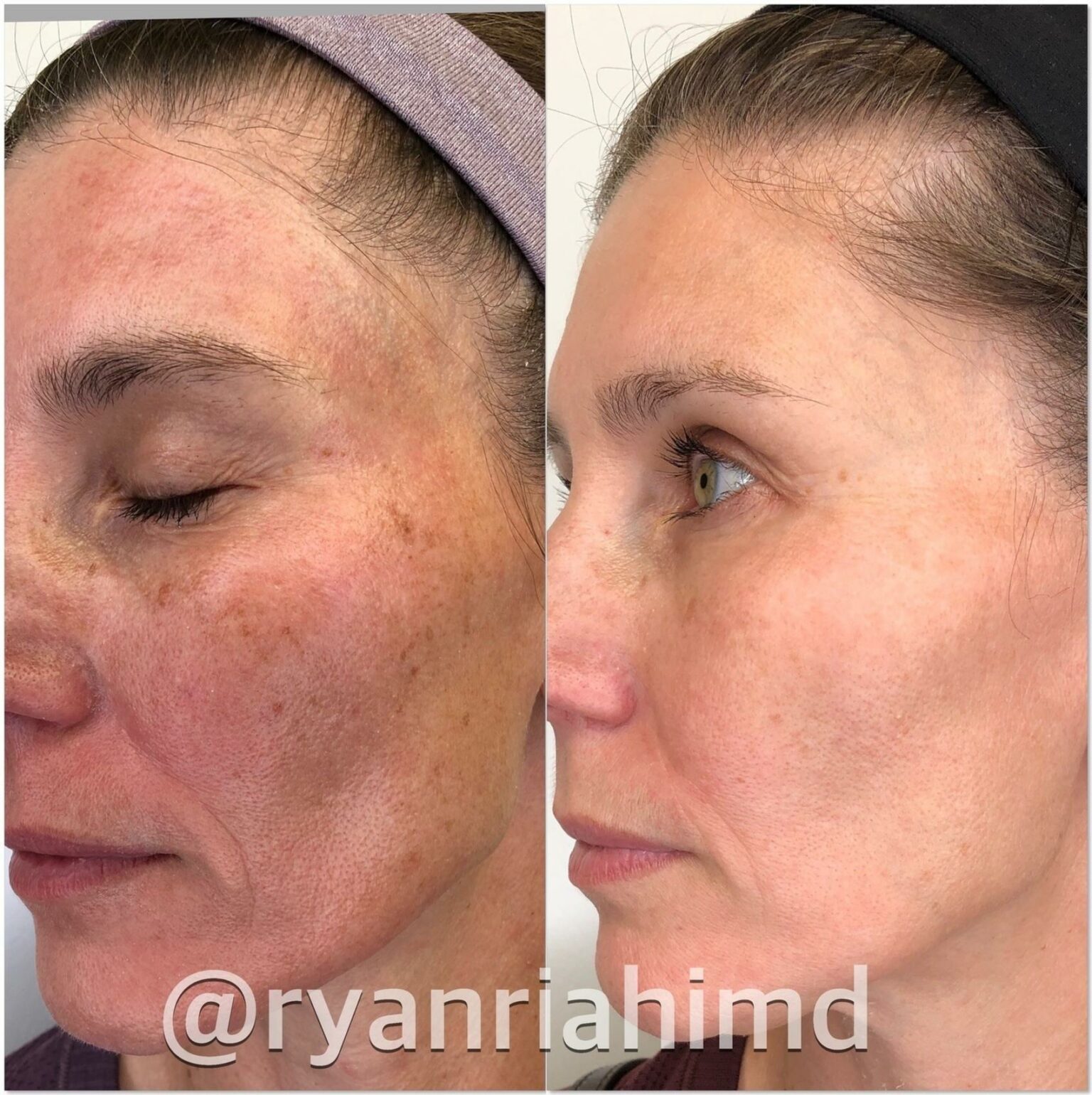 Unlock Radiant Skin: Your Guide to IPL Laser Success