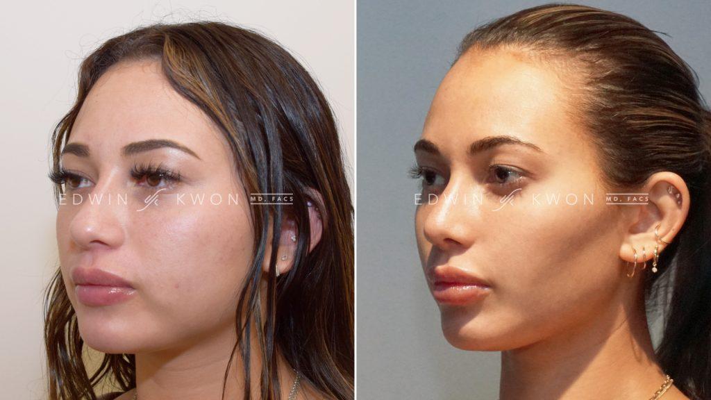 Transform Your Smile with Buccal Fat Removal in St. Louis!