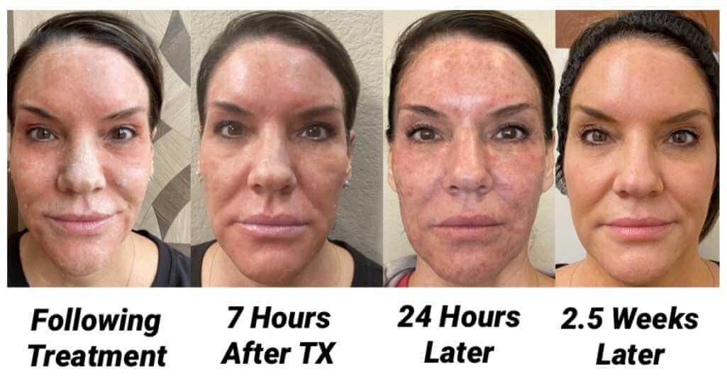 Beyond the Break: Er:YAG Laser’s Smile Savior Story!