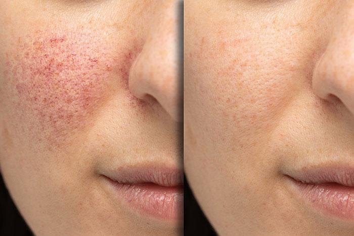 IPL Photofacials: The Glows and the Gotchas!