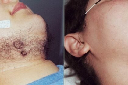 Smooth Confidence: Women’s Guide to Facial Laser Hair Removal