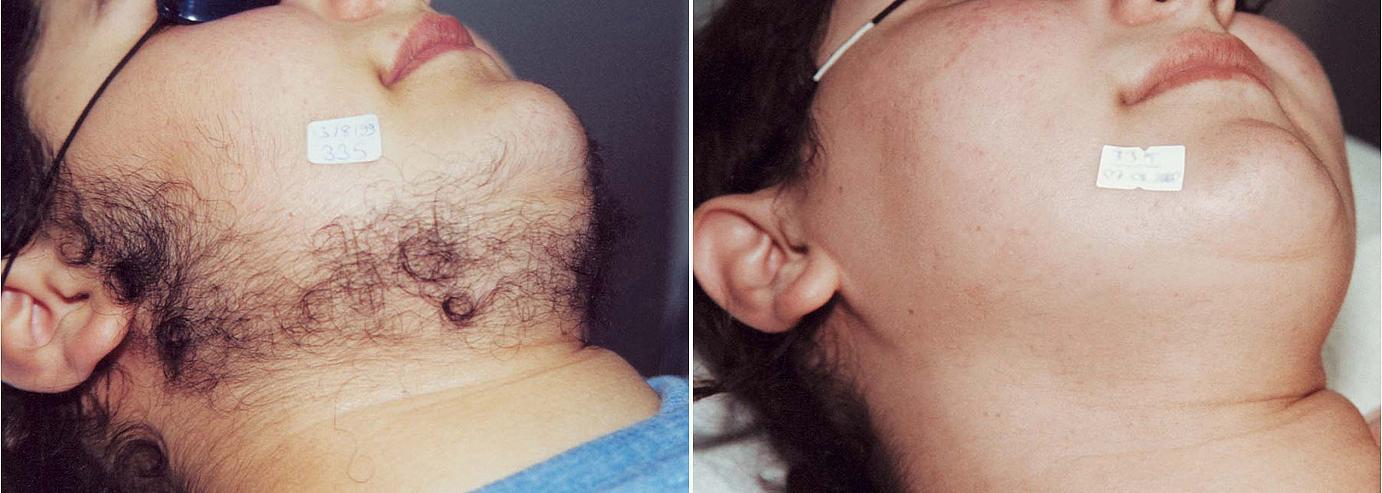 Smooth Confidence: Women’s Guide to Facial Laser Hair Removal