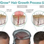 Beam Me Up, Then Down: Laser Hair Growth Side Effects