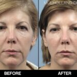 Glow & Know: Navigating CO2 Fractional Laser Side Effects