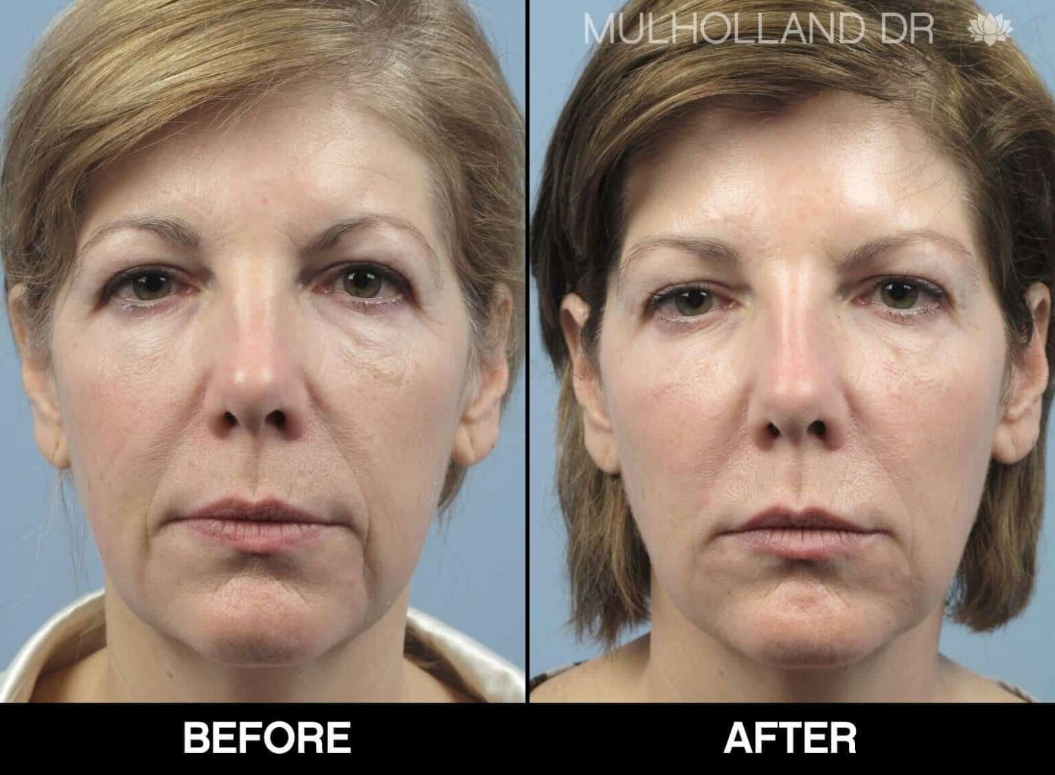 Glow & Know: Navigating CO2 Fractional Laser Side Effects