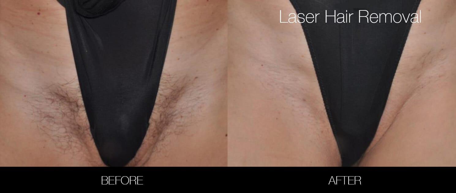 Smooth Sailing: When to Expect Results from Bikini Laser