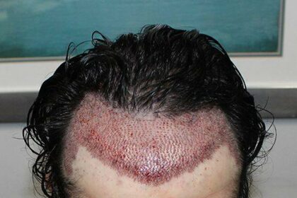 Hair Transplants Uncovered: Costs, Expectations & Tips
