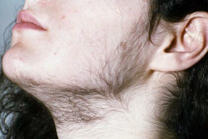 Zap Unwanted Hair: Small Area Laser Magic!