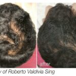 Fotona Hair Growth: Exploring the Side Effects Gently