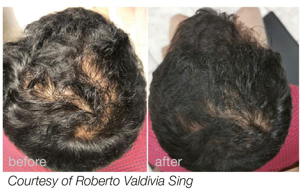 Fotona Hair Growth: Exploring the Side Effects Gently