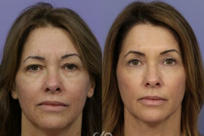 Glow Up with Laser Skin Resurfacing: Costs & Considerations 10 Glow Up with Laser Skin Resurfacing: Costs & Considerations