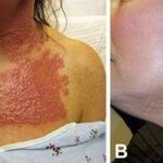 Unveiling the Glow: PDL Laser Results Timeline