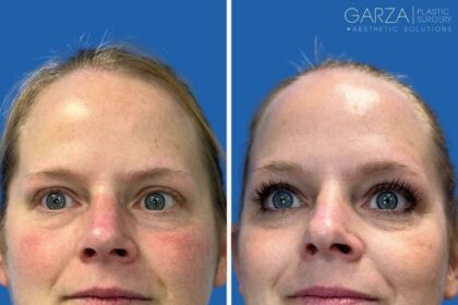 Zap Away Hair Woes: Discover the Magic of IPL Treatment