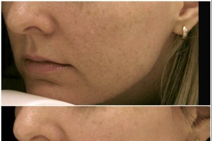 Q-Switch Laser: Navigating Facial Hair Side Effects