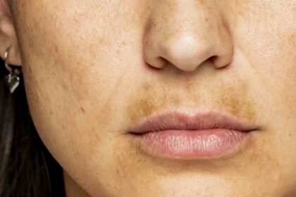 Smooth Savings: The Cost of Upper Lip Laser Hair Removal