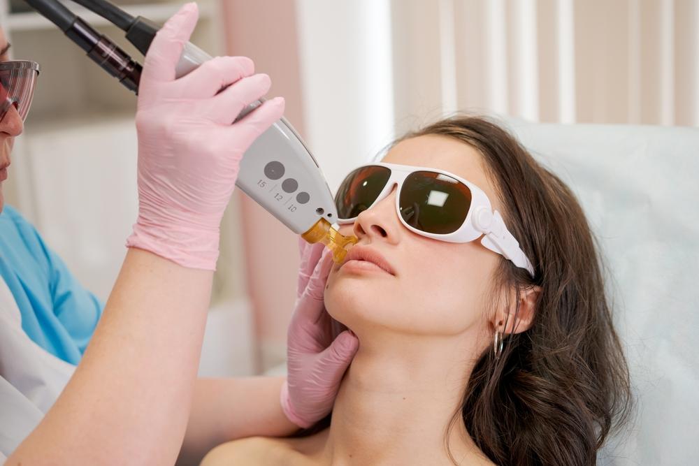 Zap Smart: Navigating Q-Switch Laser Hair Side Effects!