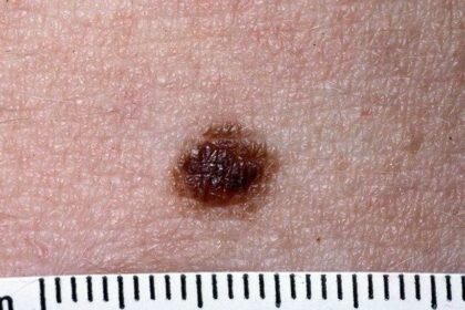 Unveiling Nevi: Clinical & Dermoscopic Insights Unmasked