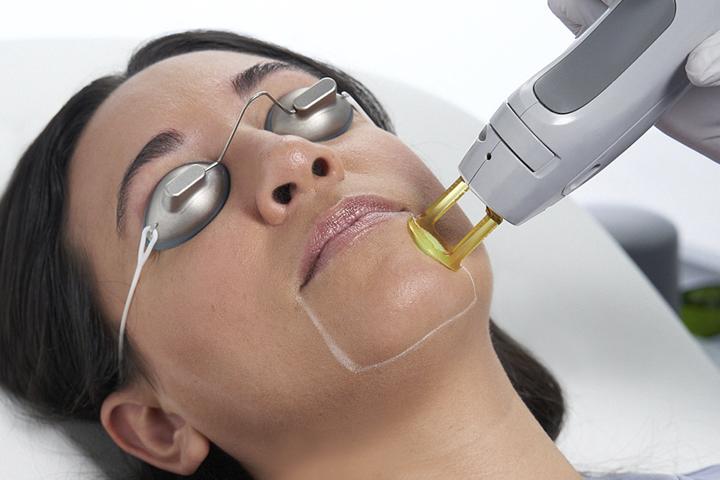Unlock Smooth Skin: Exploring Facial Laser Hair Removal Costs