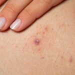 Banish Ingrown Hairs: The Laser Treatment Revolution