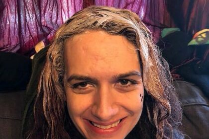 Smooth Moves: Navigating Brazilian Laser Hair Side Effects