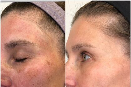 Smooth Moves: IPL Laser Hair Removal’s Ups and Downs