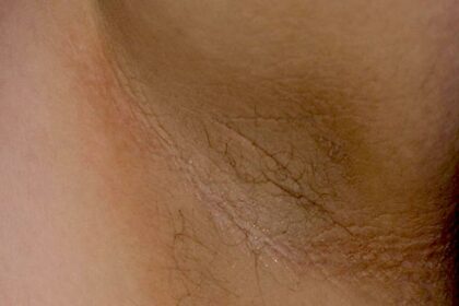 Transform Your Underarms: Laser Hair Removal Magic
