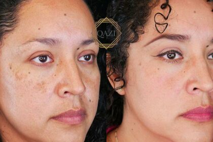 Glow Up: Discover the Marvels of Pico Laser Therapy!