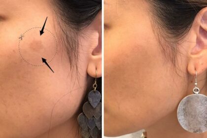 Laser Treatment: What to Expect – Side Effects Unveiled