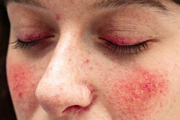 Radiant Patience: Rosacea Relief with IPL, Timed to Perfection