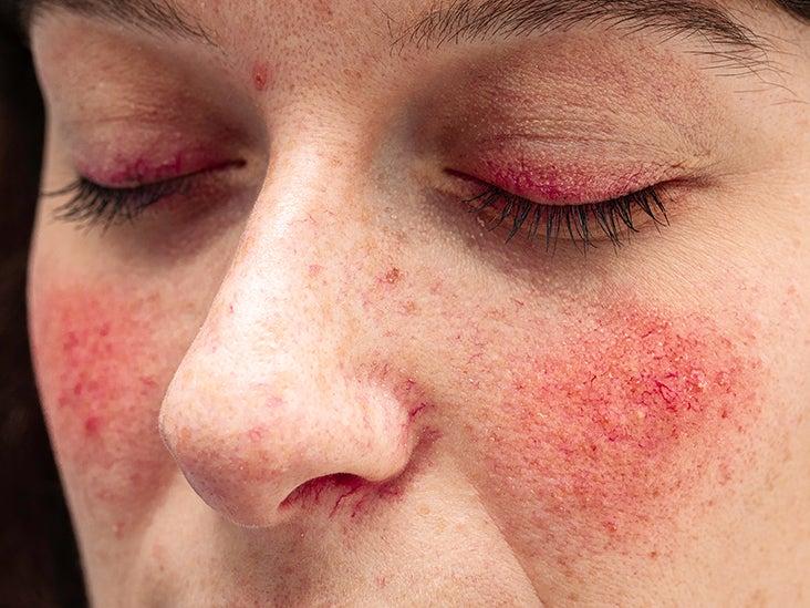 Radiant Patience: Rosacea Relief with IPL, Timed to Perfection
